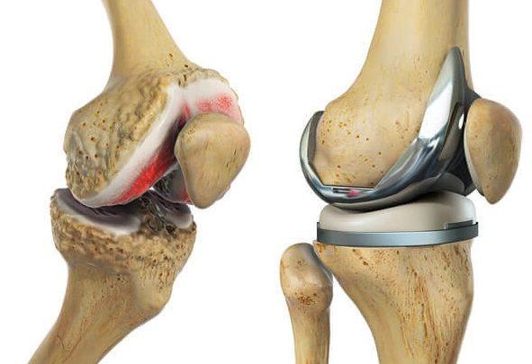Revision (Redo) Total knee Replacement for Failed Surgery
